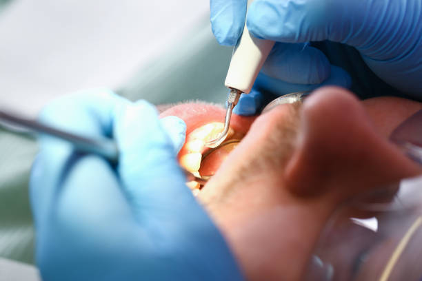 Best Emergency Dentist for Knocked-Out Tooth in Woodburn, VA